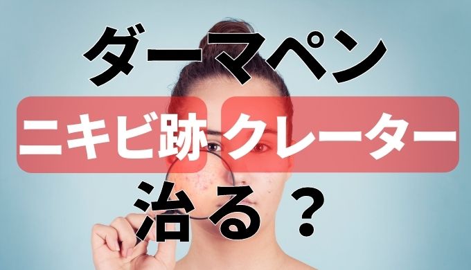 ダーマペンでクレーター ニキビ跡 が治った 悪化することはあるのか正直に紹介 美容マガジン